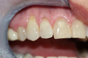Gingival recession #6,7