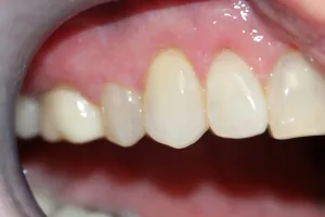Three weeks after Pinhole Surgery for gingival recession #6,7